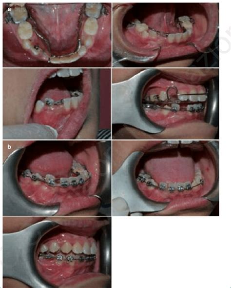 Different Phases of Braces Treatment .